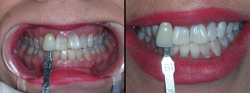 Bleaching/Whitening Teeth