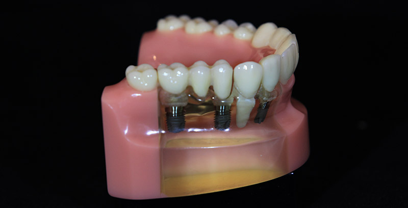 Implant Supported Bridge