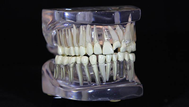 Implant Supported Crown