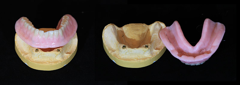 Implant Retained and Implant Supported Prosthesis